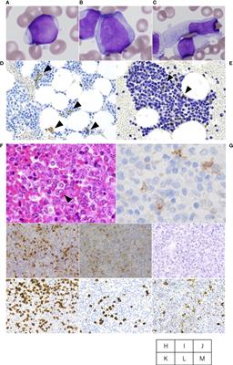 Case report: Common clonal origin of concurrent langerhans cell histiocytosis and acute myeloid leukemia